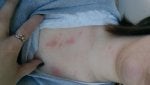 hives.jpg